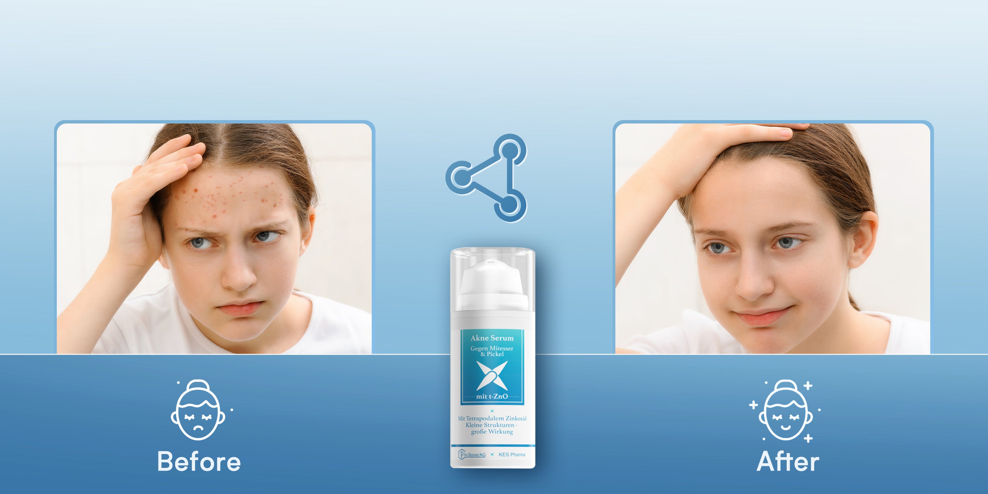 Kesnatura Acne Serum